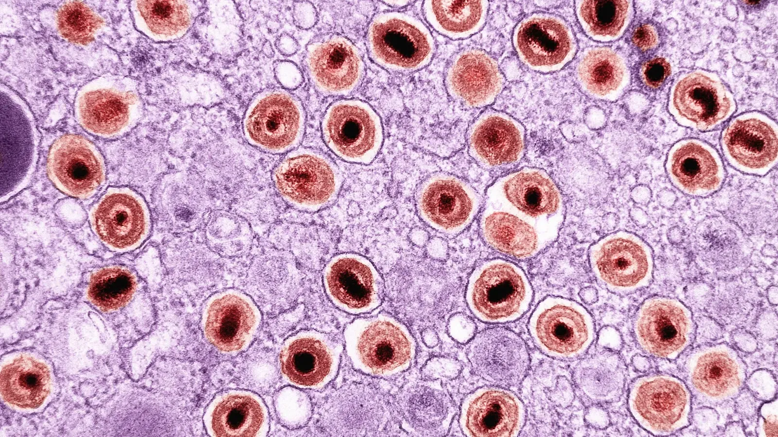 The Mechanics of a Preventable Crisis as Measles Cases Break Historic Records