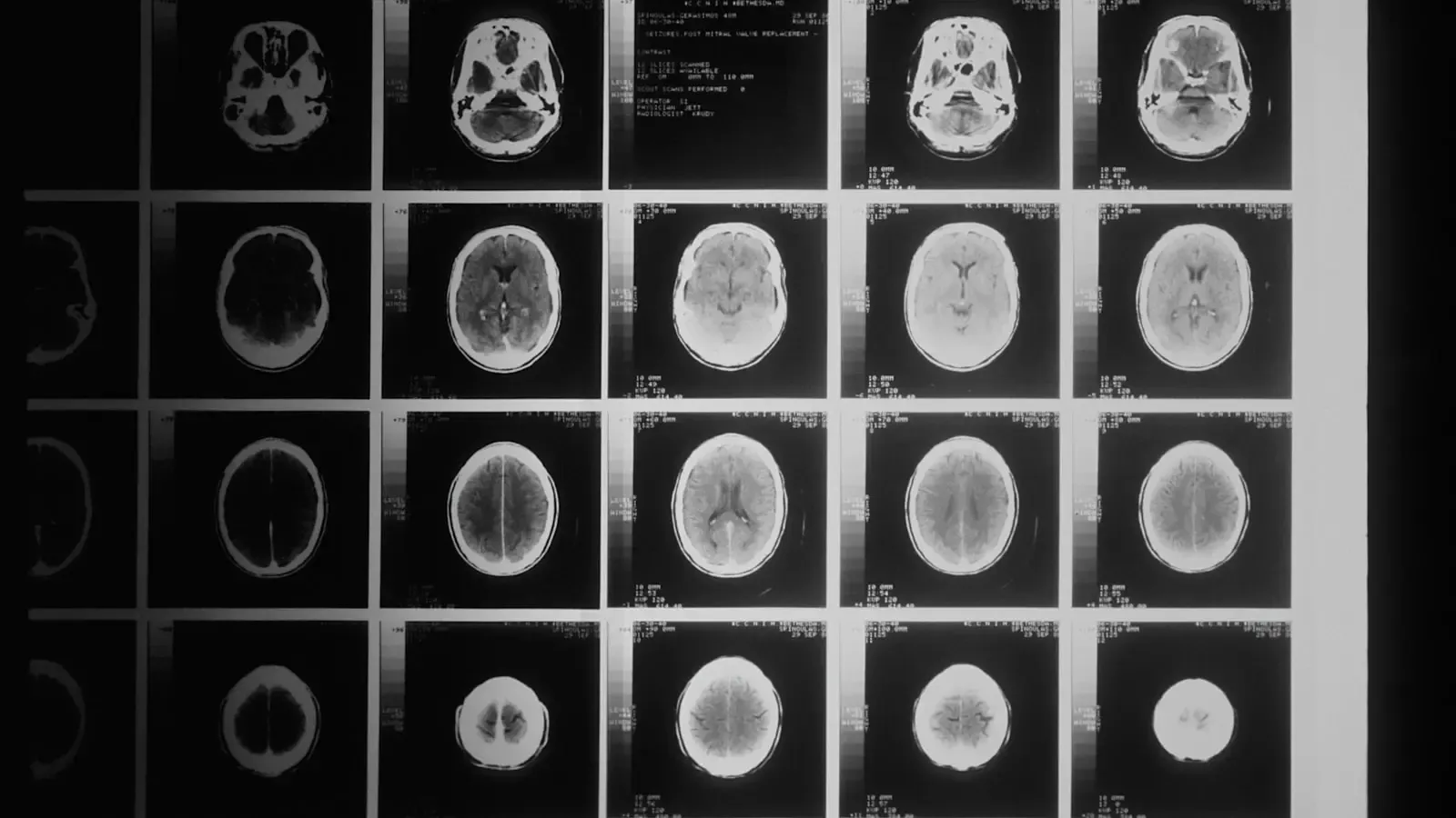 How Does Cinematic Loss of Consciousness Differ From Clinical Traumatic Brain Injury